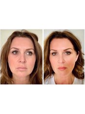 Jaw Filler - THE AESTHETIC LAB LINCOLN