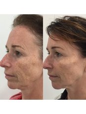 Tear Trough Under-eye Filler - THE AESTHETIC LAB LINCOLN