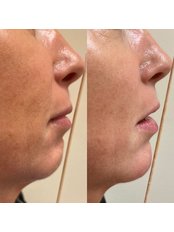 Chin Filler - THE AESTHETIC LAB LINCOLN