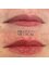 THE AESTHETIC LAB LINCOLN - Lip Augmentation  