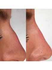 Non-surgical Rhinoplasty - THE AESTHETIC LAB LINCOLN