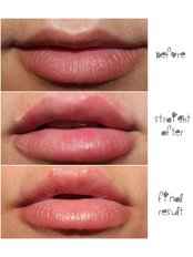 Natural Lip Augmentation - bea Skin Clinic