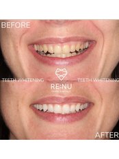 Teeth Whitening - Re:Nu Dental & Medispa