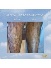 Medical Micropigmentation - Aesthetics London UK