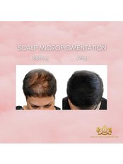 Scalp Micropigmentation - Aesthetics London UK