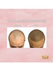Scalp Micropigmentation - Aesthetics London UK