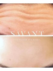 Treatment for Wrinkles - Salon Savant