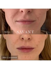 Lip Augmentation - Salon Savant