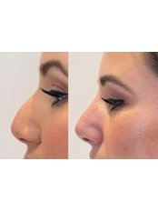 Non-Surgical Nose Job - Salon Savant