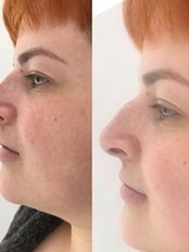 Amazing non-surgical Rhinoplasty by one of our advanced injectors!  - Altra Aesthetics