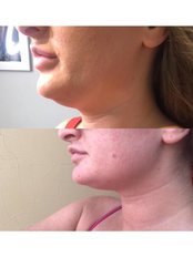 Fat dissolving. One treatment, with amazing results! Treatments available with Altra Aesthetics, administered by registered nurses.  - Altra Aesthetics