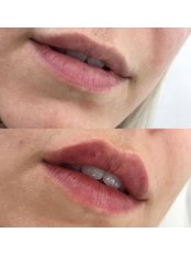 Lip Augmentation - Altra Aesthetics