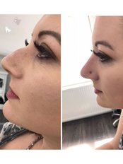An amazing non-surgical rhinoplasty transformation by our Nurse at Altra! Treatment takes around 20 minutes with minimal downtime.  - Altra Aesthetics