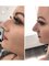 Altra Aesthetics - An amazing non-surgical rhinoplasty transformation by our Nurse at Altra! Treatment takes around 20 minutes with minimal downtime.  