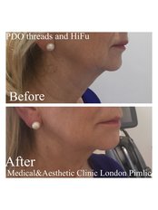 PDO Thread Lift Face and Body - Medical and Aesthetic Clinic London