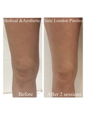Laser Lipolysis - Medical and Aesthetic Clinic London