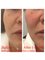 Medical and Aesthetic Clinic London - Profhilo-face lift 