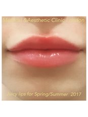 Lip Augmentation - Medical and Aesthetic Clinic London