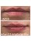 Medical and Aesthetic Clinic London - Lips 