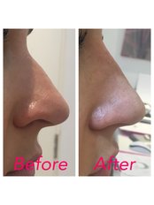 Non-Surgical Nose Job - Medical and Aesthetic Clinic London