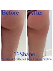 Laser Lipolysis - Medical and Aesthetic Clinic London