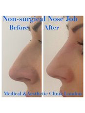 Non-Surgical Nose Job - Medical and Aesthetic Clinic London