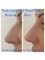 Medical and Aesthetic Clinic London - Non-surgical Nose job 