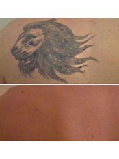 Tattoo Removal - The Tattoo Removal Experts