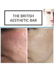 Vampire Facial Microneedling - The British Aesthetic Bar