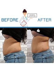 Non-Surgical Tummy Tuck (1 Session) - The British Aesthetic Bar