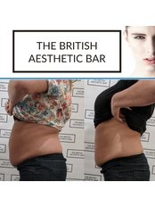Non-Surgical Tummy Tuck (3 Sessions) - The British Aesthetic Bar
