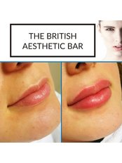 Lip Fillers - The British Aesthetic Bar