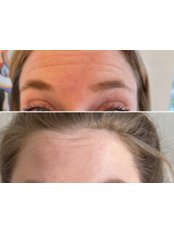 Anti Wrinkle Injections - Phi Balance Clinic