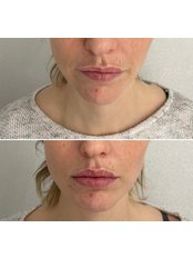 Lip Augmentation - Phi Balance Clinic