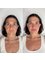 Phi Balance Clinic - 10ml Full Face Rejuvenation (Dermal Fillers) 