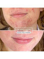 Acne Treatment - Defining Faces