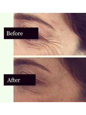 Treatment for Wrinkles - Defining Faces