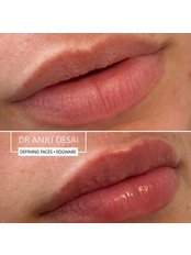 Lip enhancement (Paris Lips) - Defining Faces