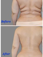 Liposuction - Dr Kay Clinic