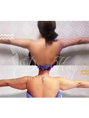 Arm Liposuction - Dr Kay Clinic