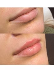 Lip Augmentation - Viva Skin Clinics- London