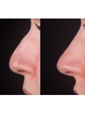 Non-Surgical Nose Job - Viva Skin Clinics- London