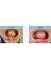 Zoom Teeth Whitening - Belle Clinic