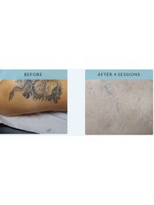 Tattoo Removal Small - Belle Clinic