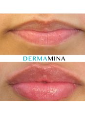 Lip Augmentation - Dermamina