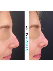 Non-Surgical Nose Job - Dermamina