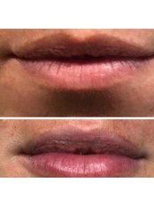 Lip Augmentation - Health & Aesthetic Clinic