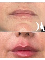 Lip Augmentation - Deep Aesthetics