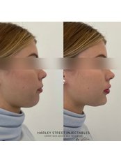 Chin Augmentation - Harley Street Injectables