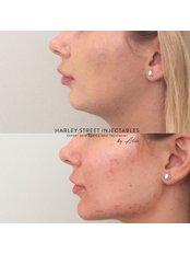 Chin and jaw contouring - Harley Street Injectables